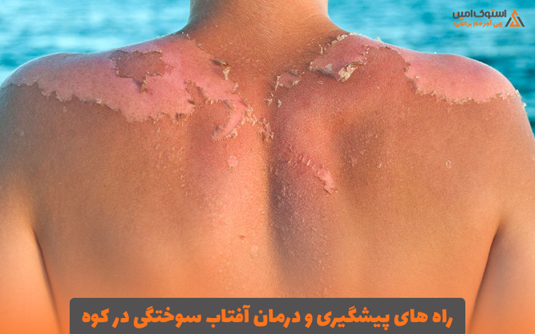 راه‌ های پیشگیری و درمان آفتاب سوختگی در کوه